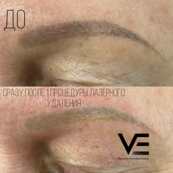 Лазерное Удаление некачественного татуажа
                    Салон краси Studio Shishenko Дніпро