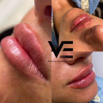 Контурная пластика
                    Салон красоты Studio Shishenko Днепр