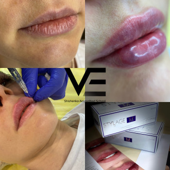 Контурная пластика
                    Салон красоты Studio Shishenko Днепр