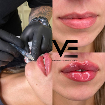 Контурная пластика
                    Салон красоты Studio Shishenko Днепр