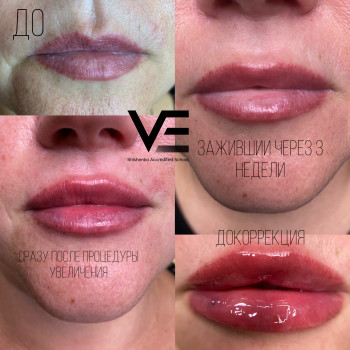 Контурная пластика
                    Салон красоты Studio Shishenko Днепр