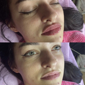 Контурная пластика губ
                    Косметолог-инъекционист Alisa Кривой Рог