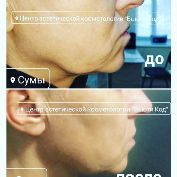 процедура #SMASліфтингу на апараті Ulthera SmasTherapy