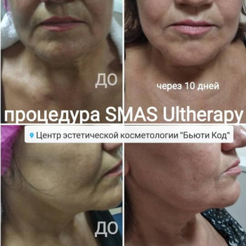 СМАС лица, кл.64г, разница до и после процедуры в 10 дней