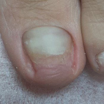 Вросший ноготь
                    Подолог Виктория Гайсин