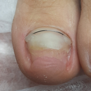 Вросший ноготь
                    Подолог Виктория Гайсин