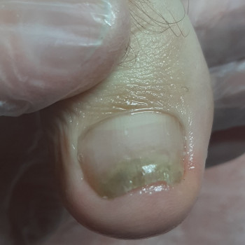 Вросший ноготь
                    Подолог Виктория Гайсин