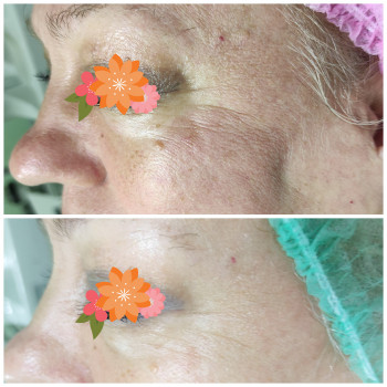 Пилинг Macro peel
                    Косметолог Елена Днепр