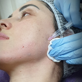 Биоревитализация кожи