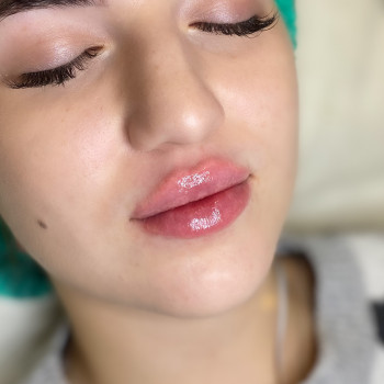 Контурна пластика губ
                    Косметолог-ін'єкціоніст Юлія Львів