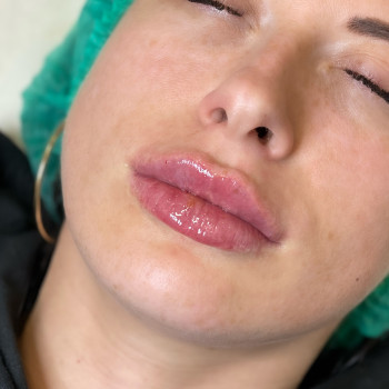 Контурна пластика губ
                    Косметолог-ін'єкціоніст Юлія Львів