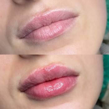 Контурна пластика губ
                    Косметолог-ін'єкціоніст Юлія Львів