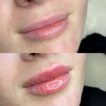 Контурна пластика губ
                    Косметолог-ін'єкціоніст Юлія Львів