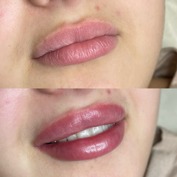 Контурна пластика губ
                    Косметолог-ін'єкціоніст Юлія Львів
