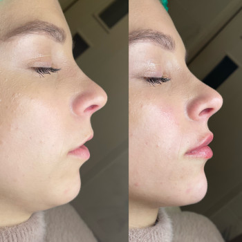 Контурна пластика губ
                    Косметолог-ін'єкціоніст Юлія Львів