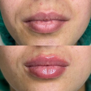 Контурна пластика губ
                    Косметолог-ін'єкціоніст Юлія Львів