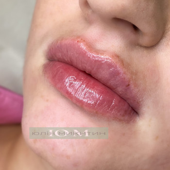 Контурна пластика губ
                    Косметолог-ін'єкціоніст Юлія Львів