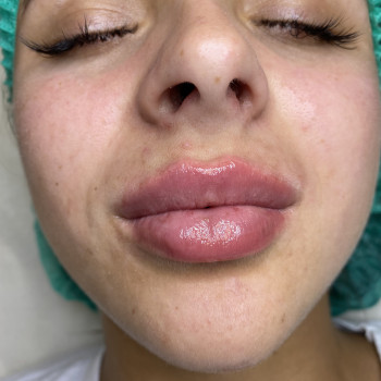 Контурна пластика губ
                    Косметолог-ін'єкціоніст Юлія Львів