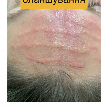 Бланшинг