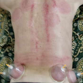 коррекция позвоночника