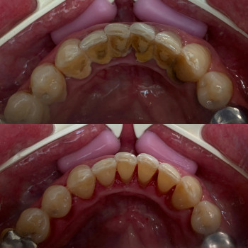 Виконано професійну гігієну ротової порожнини , зняття зубно