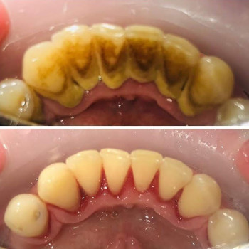 Чистка зубов
                    Стоматолог Виктория Харьков