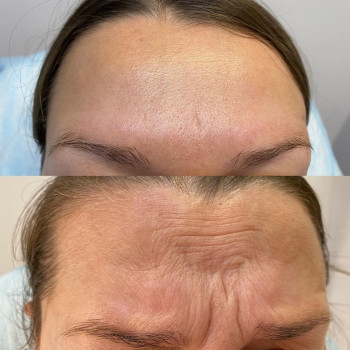 Нейронокс, зона лба