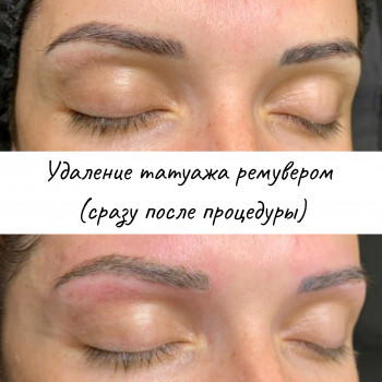 Удаление татуажа ремувером
                    Бровист Марина Одесса