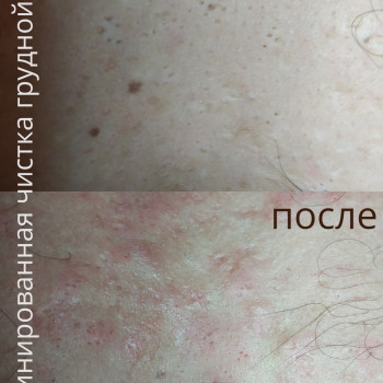 механическая чистка грудной клетки мужчине