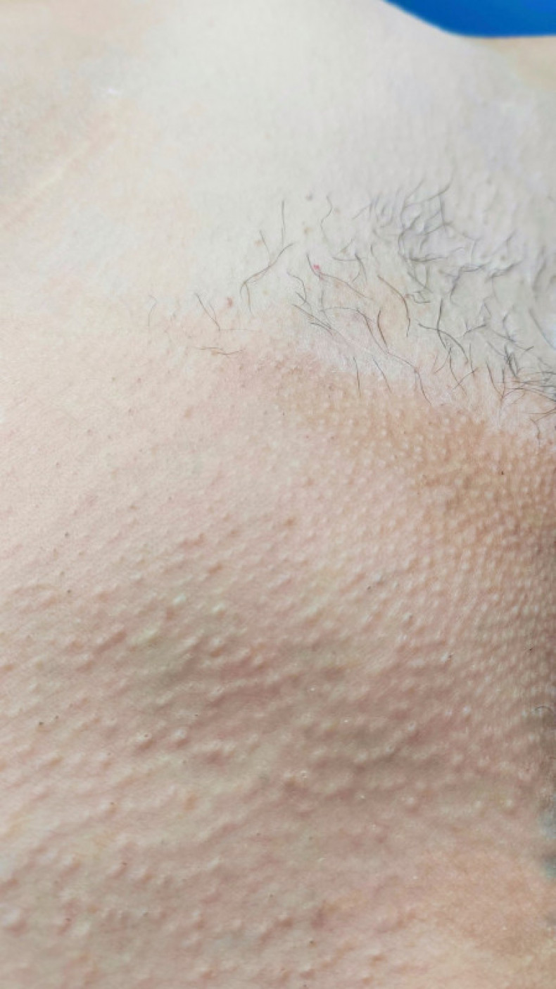 Порівняння шкіри одразу після депіляції бікіні., фото - Мастер депиляции Оксана Білик