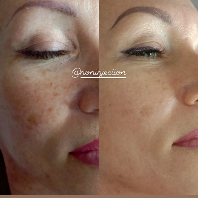 Холодная плазма, фото - Косметолог Ольга Питюл