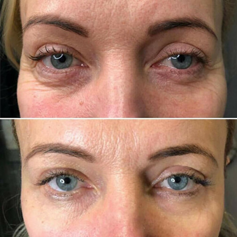 Холодная плазма, блефаропластика, фото - Косметолог Ольга Питюл