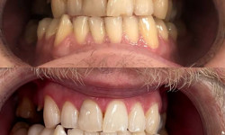 Косметическое отбеливание зубов Стоматологическая клиника Smile Lab Odessa Одесса