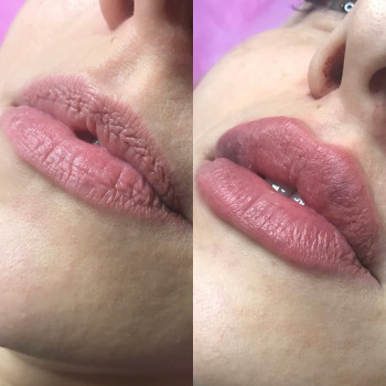 Коррекция и увеличение губ