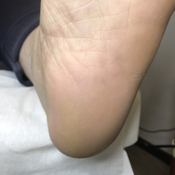 Результат аппаратного педикюра. Листайте и будет фото "до"