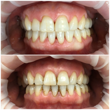 Професійна гігієна ротової порожнини