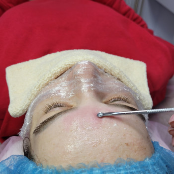 Механическая чистка лица