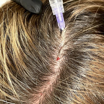 Мезотерапія голови (Hair loss control) Іспанія
                    Косметолог Людмила Киев