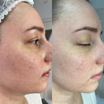 Процедура масажу. Зменшились набряки і почервоніння. Підтягн