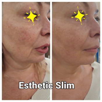  
Коррекция брылей(нижняя треть)
До та після