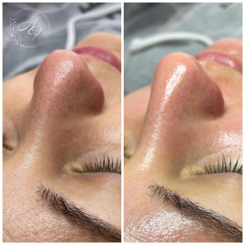 Чистка обличчя