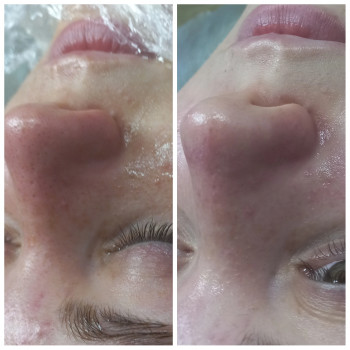 Чистка обличчя + Альгінатна маска у подарунок!
                    Косметолог Лілія Винница