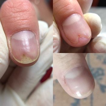 Онихолизис