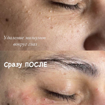 Удаление милиумов