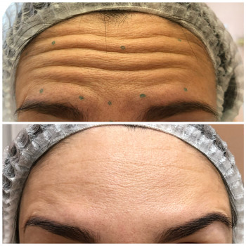 Ботулинотерапия, фото в динамике через 2 недели