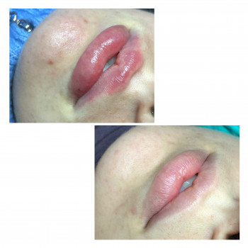 Контурная пластика губ, препаратом Нейрамис Дип