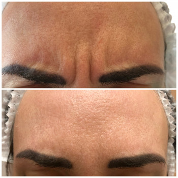 Ботулинотерапия, фото через 2 недели в динамике