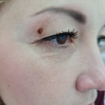 Видалення новоутворень
                    Косметолог Мария Киев