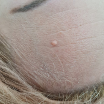 Видалення новоутворень
                    Косметолог Мария Киев