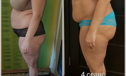 Общий курс антицеллюлитного массажа Массажист Вика Одесса